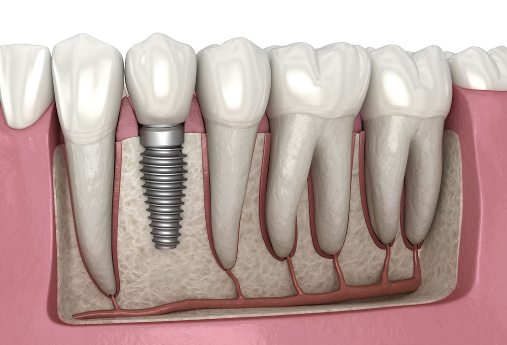 Dental-implant-illustration